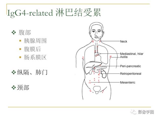 【PPT】IgG4相关性系统性疾病——从自身免疫性胰腺炎说起