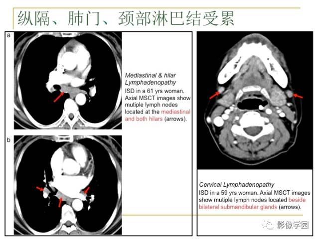 【PPT】IgG4相关性系统性疾病——从自身免疫性胰腺炎说起