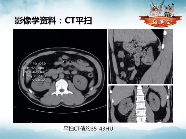 【病例】乳头状肾细胞癌1例CT及MR影像解析