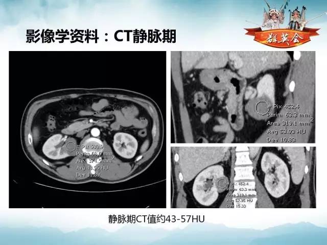 【病例】乳头状肾细胞癌1例CT及MR影像解析