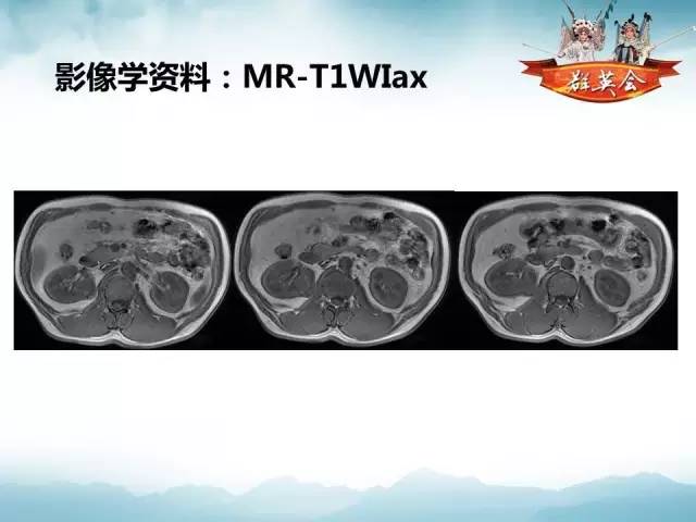 【病例】乳头状肾细胞癌1例CT及MR影像解析