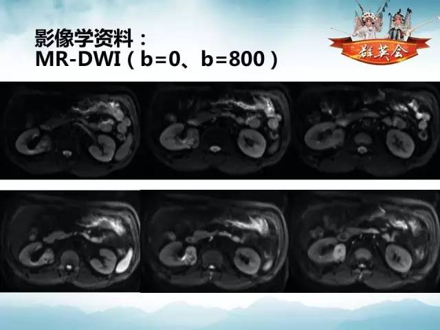 【病例】乳头状肾细胞癌1例CT及MR影像解析