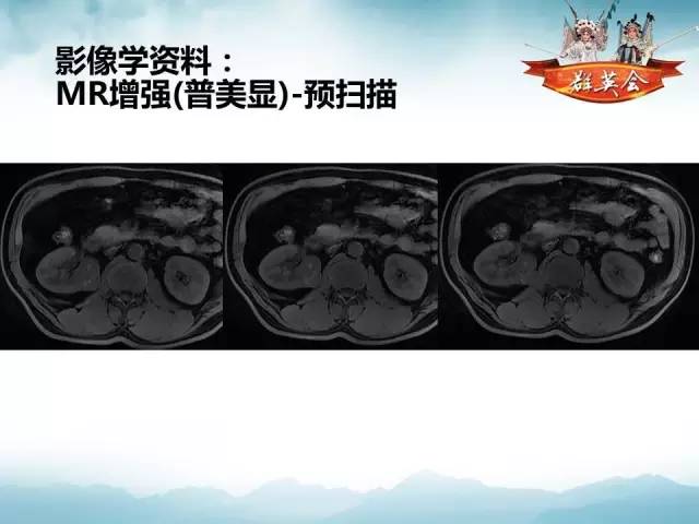 【病例】乳头状肾细胞癌1例CT及MR影像解析