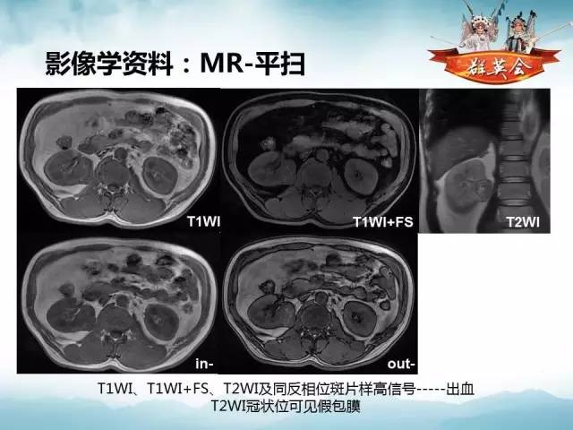【病例】乳头状肾细胞癌1例CT及MR影像解析