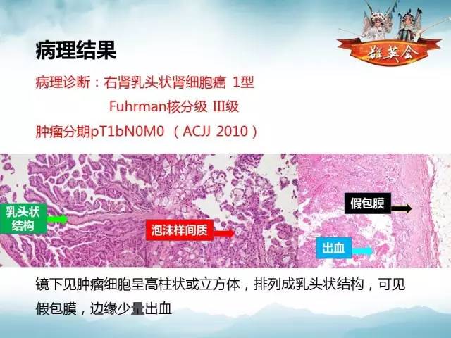 【病例】乳头状肾细胞癌1例CT及MR影像解析
