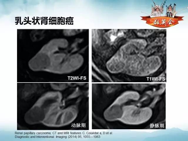 【病例】乳头状肾细胞癌1例CT及MR影像解析
