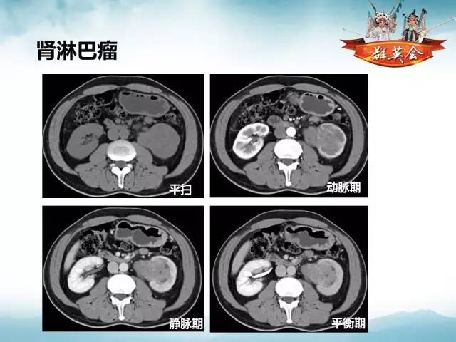 【病例】乳头状肾细胞癌1例CT及MR影像解析