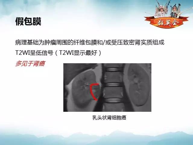 【病例】乳头状肾细胞癌1例CT及MR影像解析