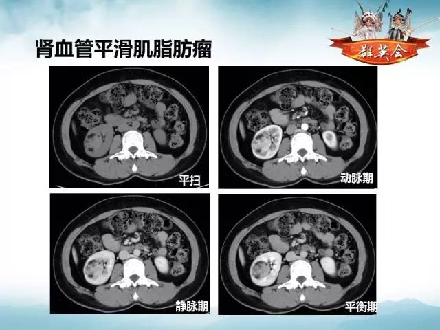 【病例】乳头状肾细胞癌1例CT及MR影像解析