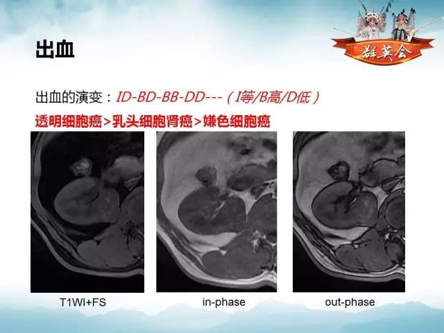 【病例】乳头状肾细胞癌1例CT及MR影像解析