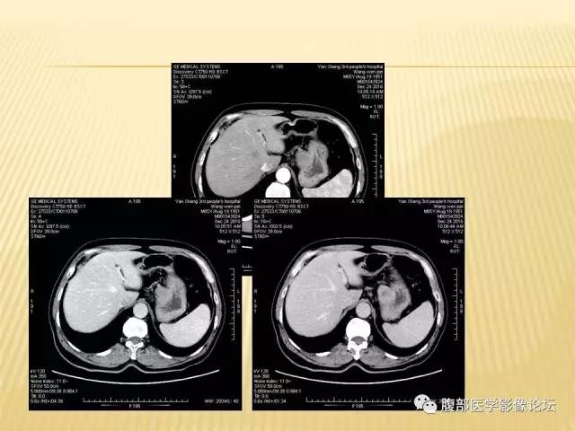 【病例】胃神经鞘瘤1例CT影像表现 【病例】胃神经鞘瘤1例CT影像表现