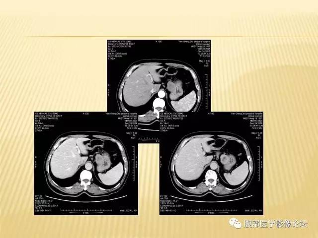 【病例】胃神经鞘瘤1例CT影像表现 【病例】胃神经鞘瘤1例CT影像表现