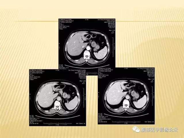 【病例】胃神经鞘瘤1例CT影像表现 【病例】胃神经鞘瘤1例CT影像表现