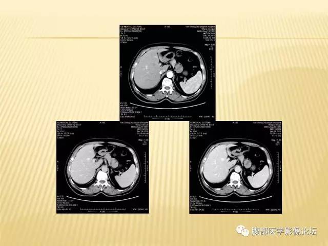 【病例】胃神经鞘瘤1例CT影像表现 【病例】胃神经鞘瘤1例CT影像表现