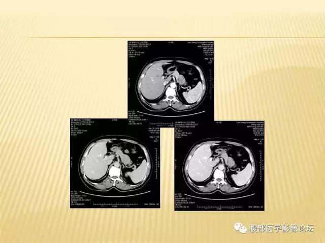【病例】胃神经鞘瘤1例CT影像表现 【病例】胃神经鞘瘤1例CT影像表现