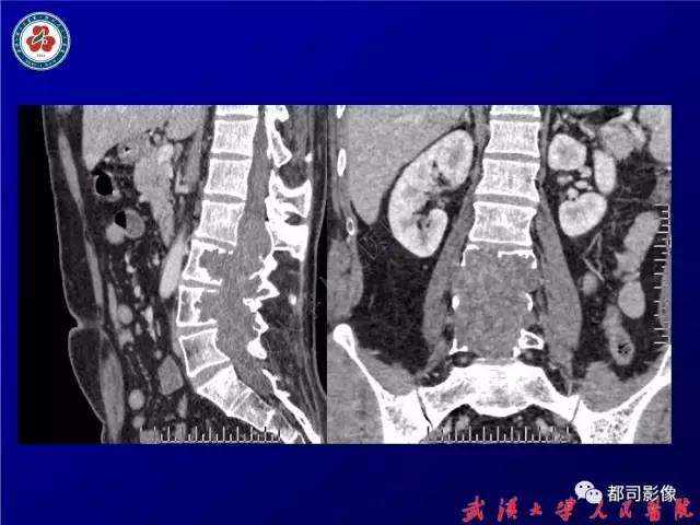 【病例】腰骶段椎管巨大神经鞘瘤1例MR影像诊断