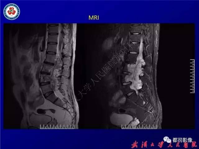 【病例】腰骶段椎管巨大神经鞘瘤1例MR影像诊断