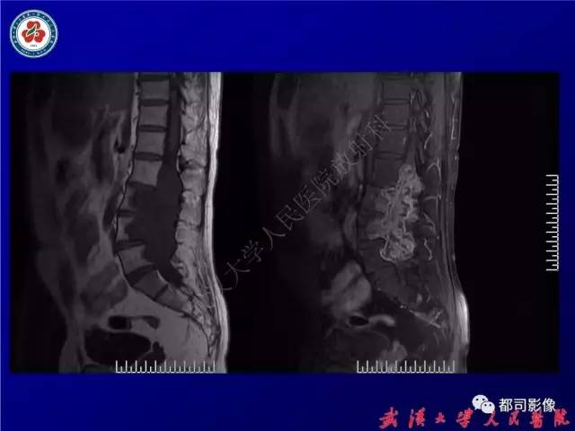 【病例】腰骶段椎管巨大神经鞘瘤1例MR影像诊断