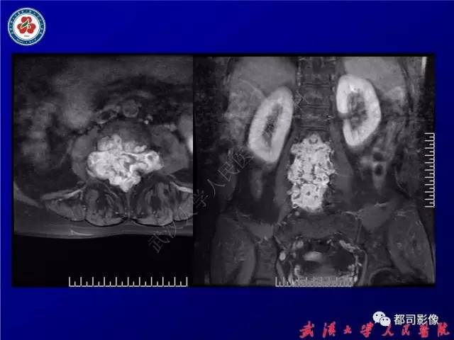 【病例】腰骶段椎管巨大神经鞘瘤1例MR影像诊断