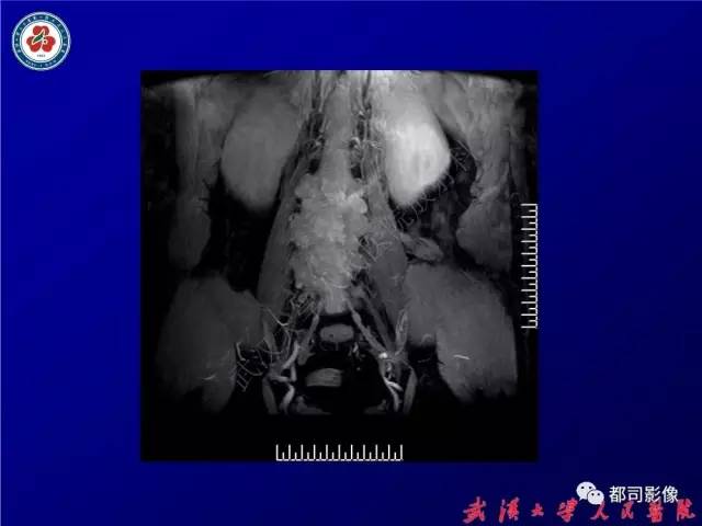 【病例】腰骶段椎管巨大神经鞘瘤1例MR影像诊断