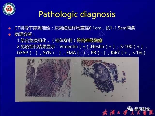 【病例】腰骶段椎管巨大神经鞘瘤1例MR影像诊断