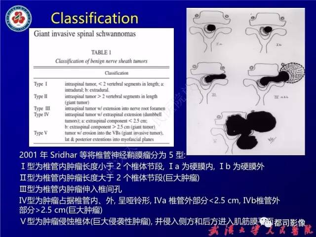 【病例】腰骶段椎管巨大神经鞘瘤1例MR影像诊断