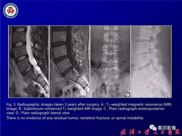 【病例】腰骶段椎管巨大神经鞘瘤1例MR影像诊断