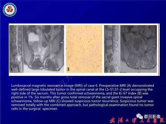 【病例】腰骶段椎管巨大神经鞘瘤1例MR影像诊断