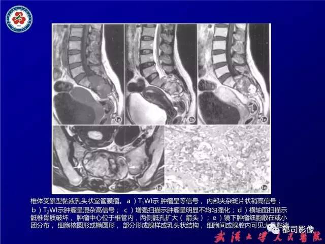 【病例】腰骶段椎管巨大神经鞘瘤1例MR影像诊断