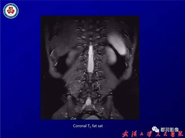 【病例】腰骶段椎管巨大神经鞘瘤1例MR影像诊断