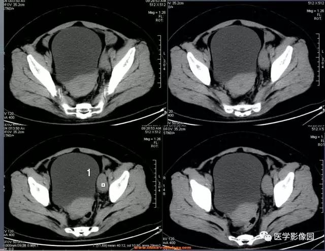 【病例】盆腔巨淋巴结增生症1例CT影像表现 【病例】盆腔巨淋巴结增生症1例CT影像表现