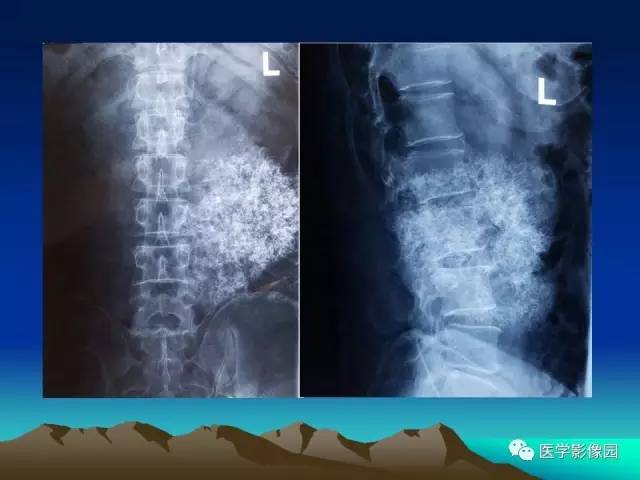 【病例】腰椎软骨肉瘤1例CT及MR