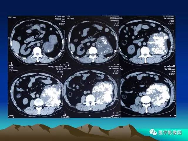 【病例】腰椎软骨肉瘤1例CT及MR