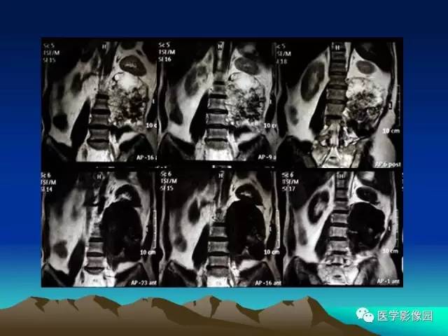 【病例】腰椎软骨肉瘤1例CT及MR