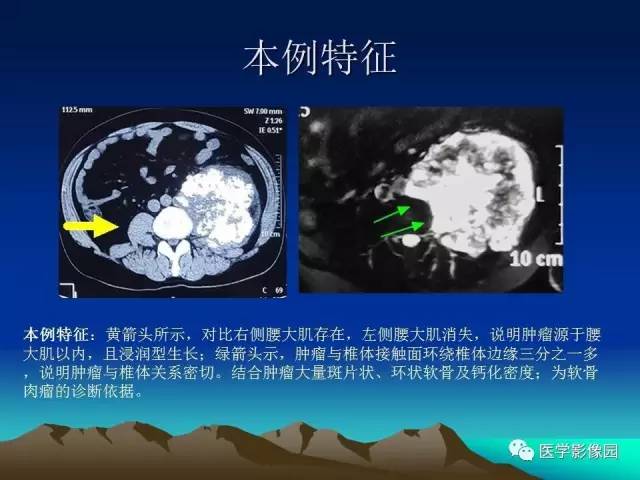 【病例】腰椎软骨肉瘤1例CT及MR