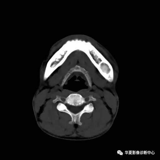【病例】下颌骨纤维结构不良1例CT