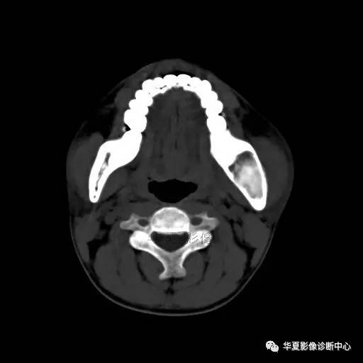 【病例】下颌骨纤维结构不良1例CT 【病例】下颌骨纤维结构不良1例CT