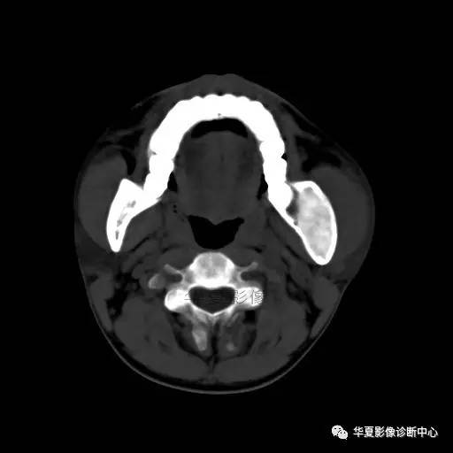 【病例】下颌骨纤维结构不良1例CT 【病例】下颌骨纤维结构不良1例CT