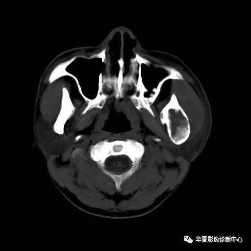 【病例】下颌骨纤维结构不良1例CT 【病例】下颌骨纤维结构不良1例CT