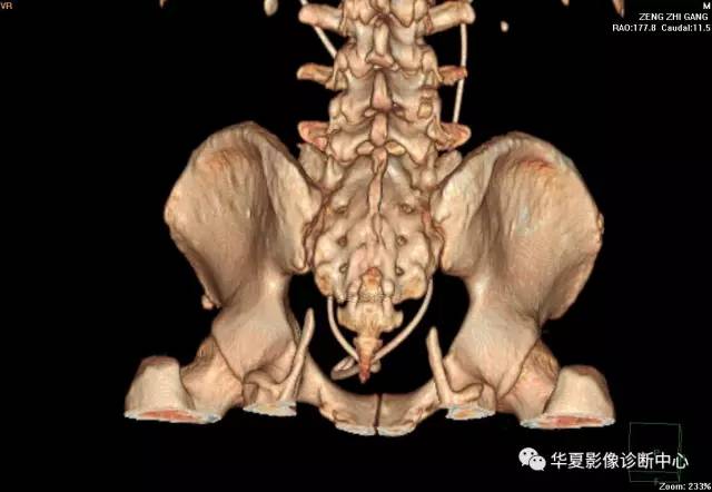 【病例】骶结节韧带钙化1例X线CT