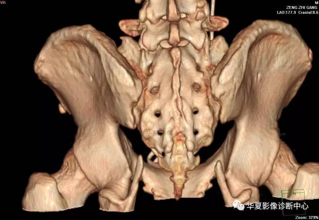【病例】骶结节韧带钙化1例X线CT