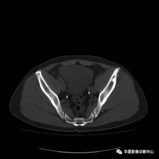 【病例】骶结节韧带钙化1例X线CT