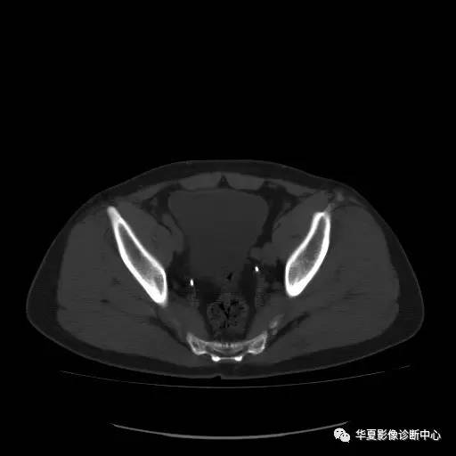 【病例】骶结节韧带钙化1例X线CT