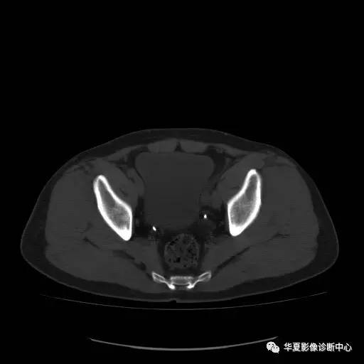 【病例】骶结节韧带钙化1例X线CT