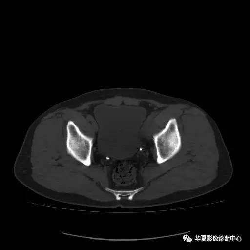 【病例】骶结节韧带钙化1例X线CT