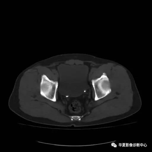 【病例】骶结节韧带钙化1例X线CT