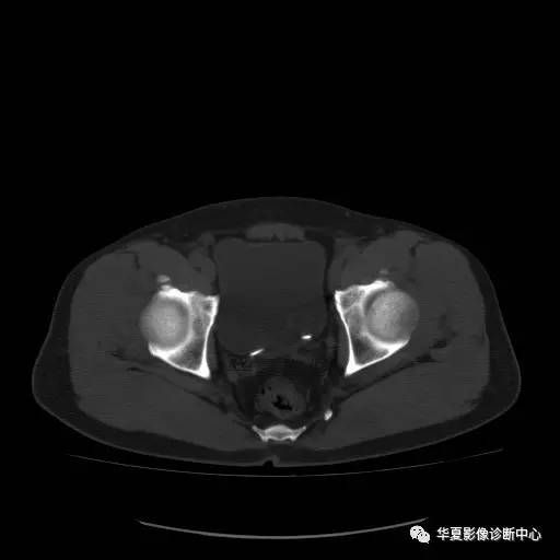 【病例】骶结节韧带钙化1例X线CT