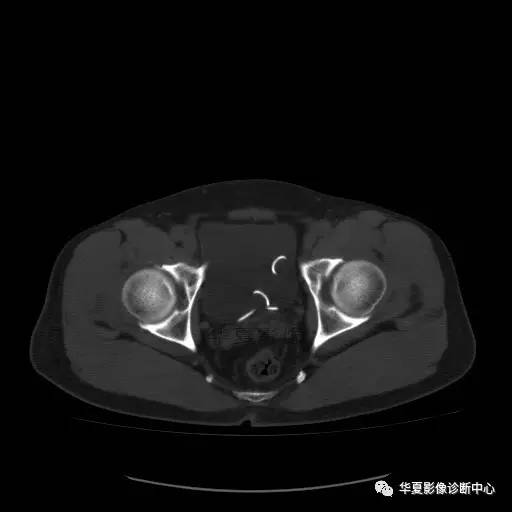 【病例】骶结节韧带钙化1例X线CT