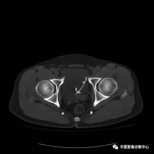 【病例】骶结节韧带钙化1例X线CT