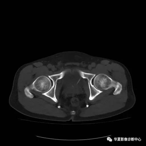 【病例】骶结节韧带钙化1例X线CT